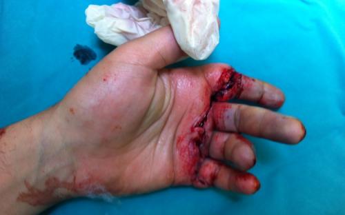 Μικροχειρουργική | Χειρουργική Χεριών - Ελλάδα Παπαδογεώργου
