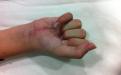 Δύο μήνες μετεγχειρητικά ο ασθενής έχει ήδη σχεδόν πλήρη ενεργητική κάμψη σε όλες τις αρθρώσεις του δακτύλου