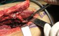 η λήψη της ετερόπλευρης περόνης με τα αγγεία της, από το πόδι του ασθενούς 